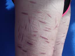 What it looks like - Self-harm is not at all ok